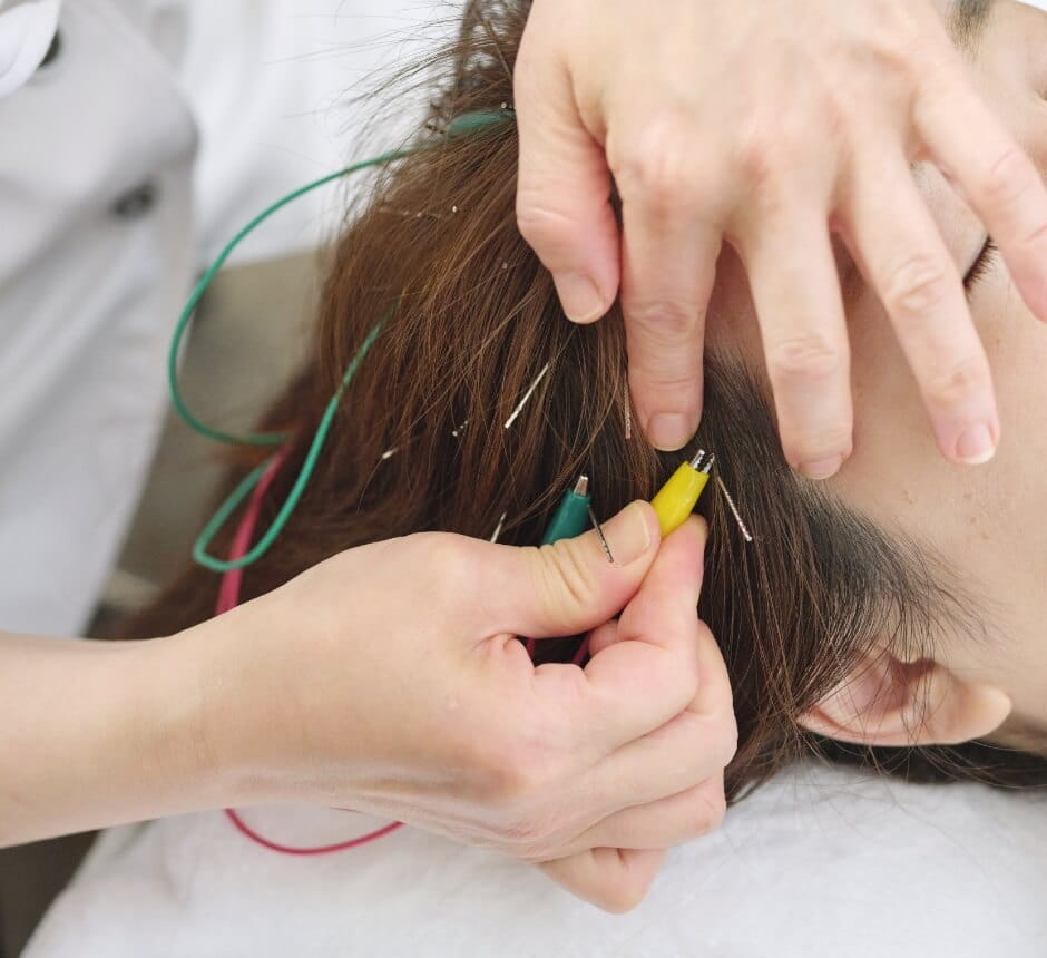 式田式育毛はり療法