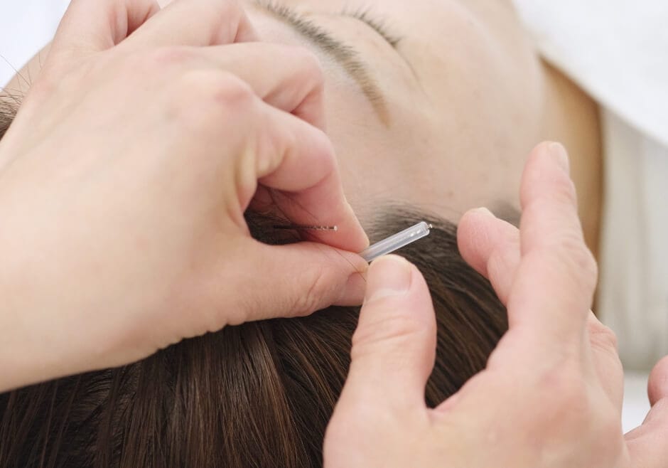 髪が育つ頭皮をつくる「式田式育毛はり療法」